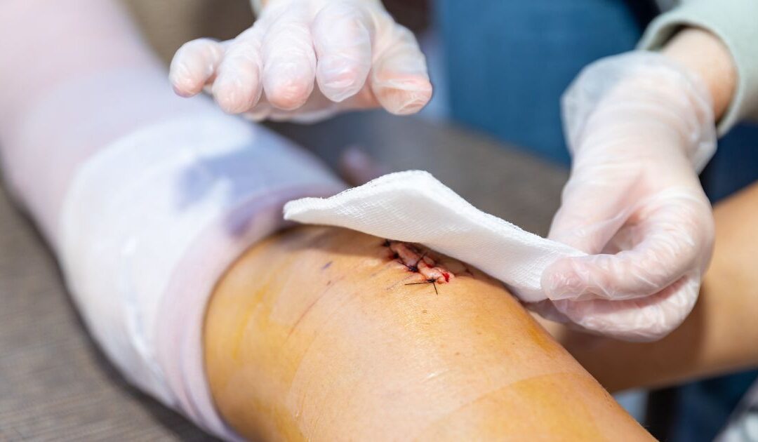 A person with gloved hands dresses a stitched wound on someone's bandaged leg.