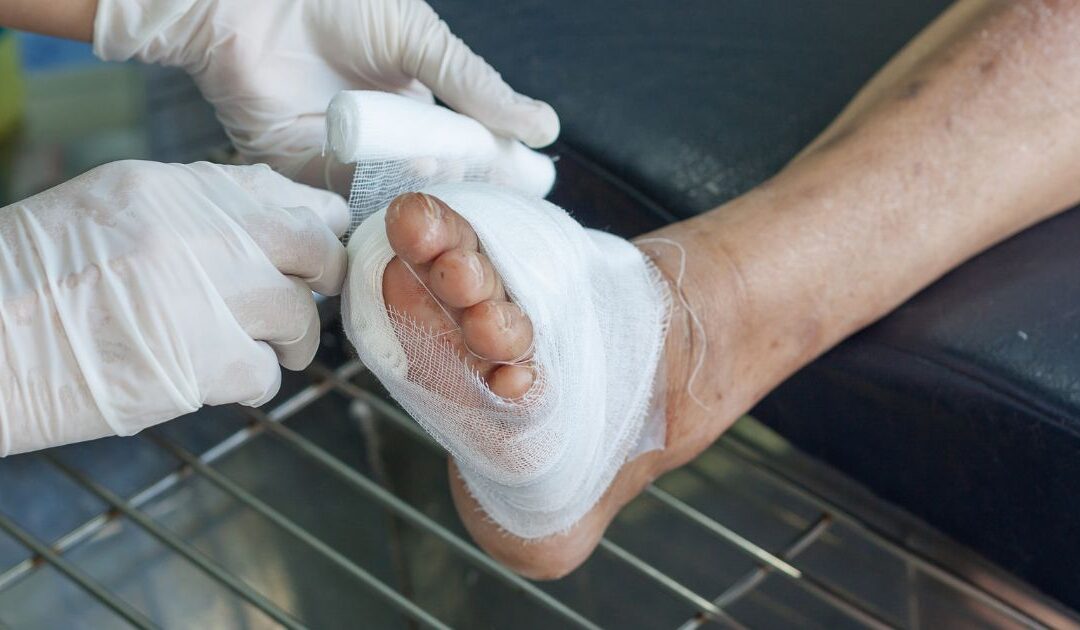 Comprehensive Guide to HBOT for Diabetic Foot Ulcers