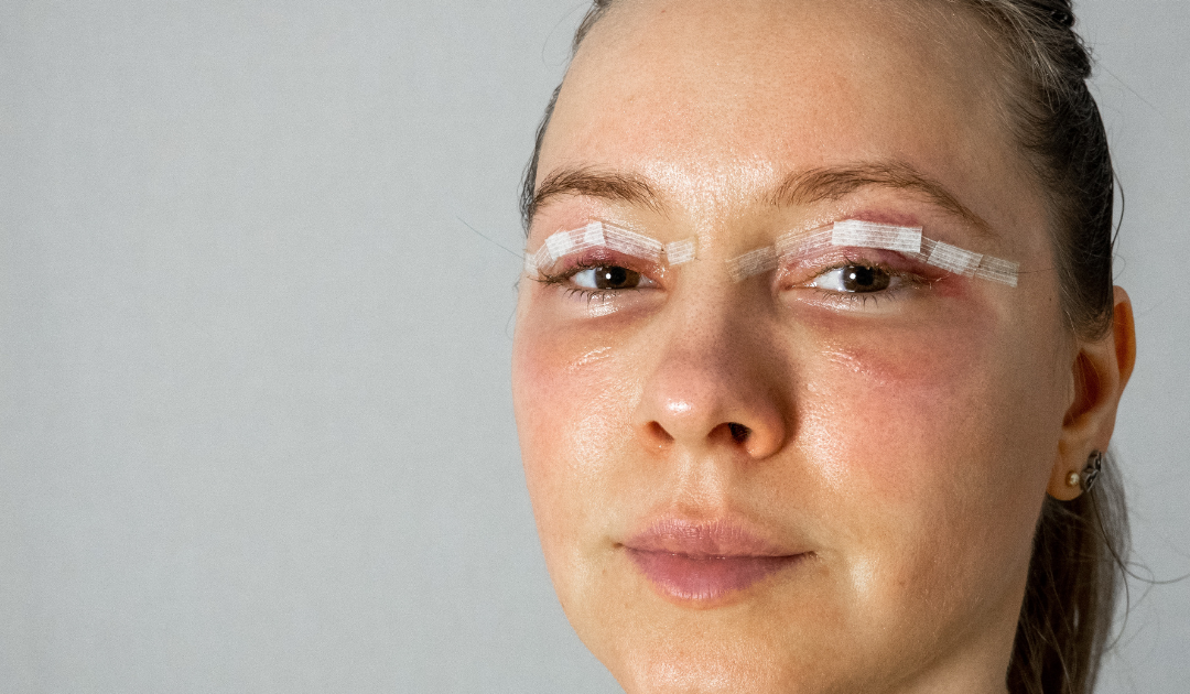 Does Hyperbaric Oxygen Therapy Reduce Swelling and Bruising Faster?