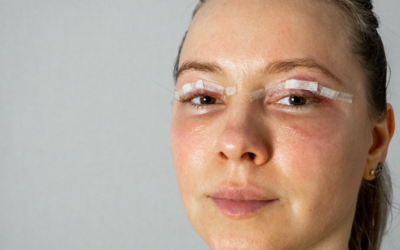 Does Hyperbaric Oxygen Therapy Reduce Swelling and Bruising Faster?